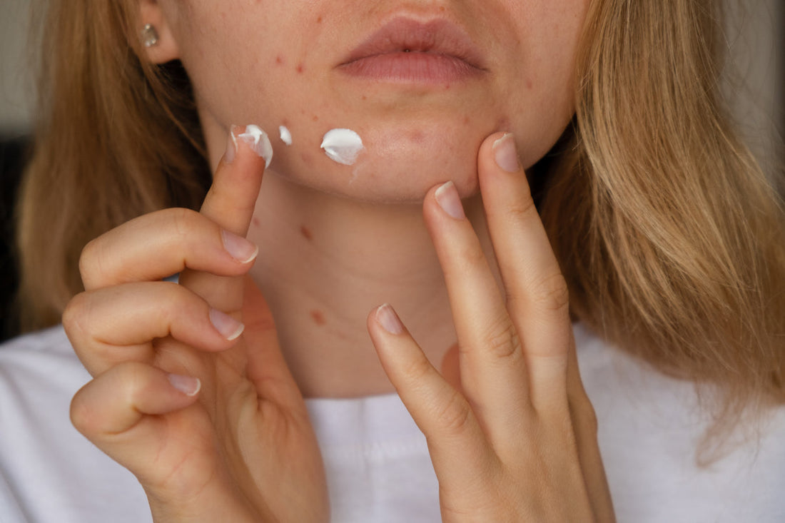 CeraVe Skincare: Which Products Are Best For Acne-Prone Skin?