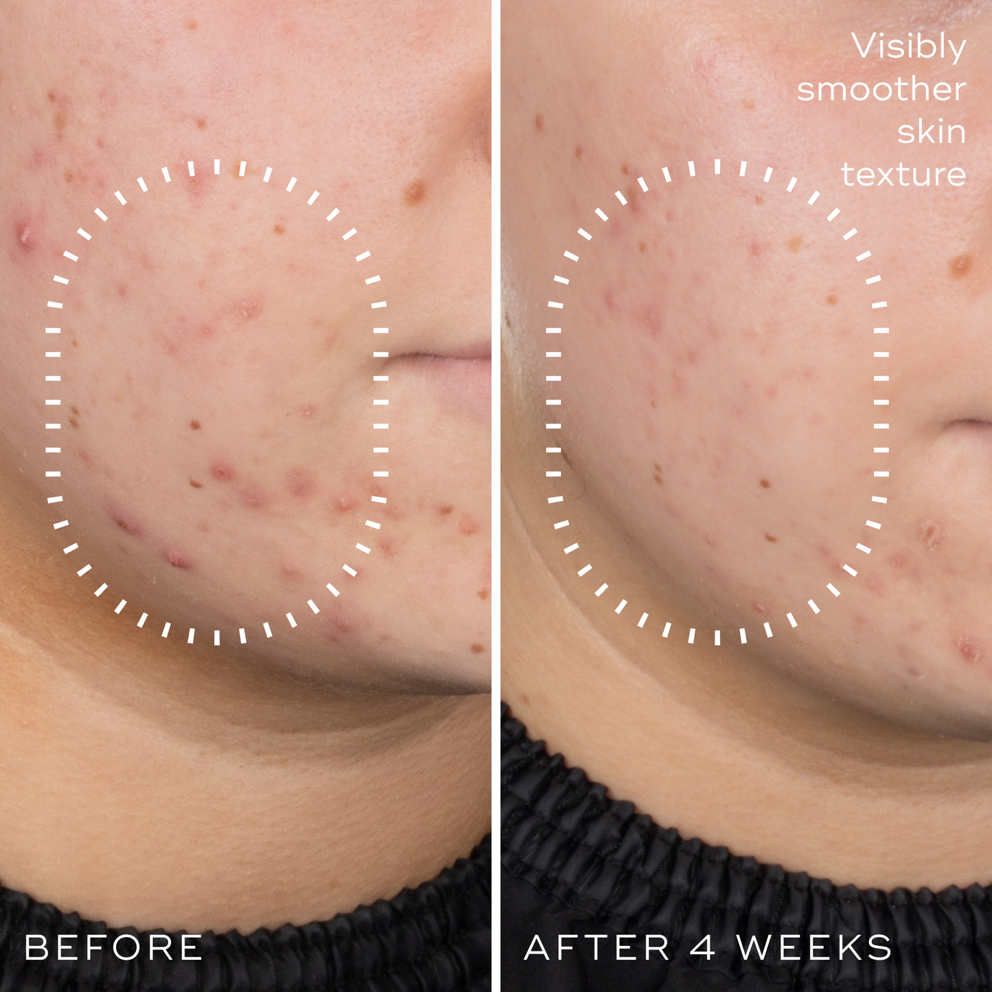 Before and after photographs of a woman's cheek after 4 weeks using Medik8 Niacinamide Peptides, showing visibly smoother skin texture.