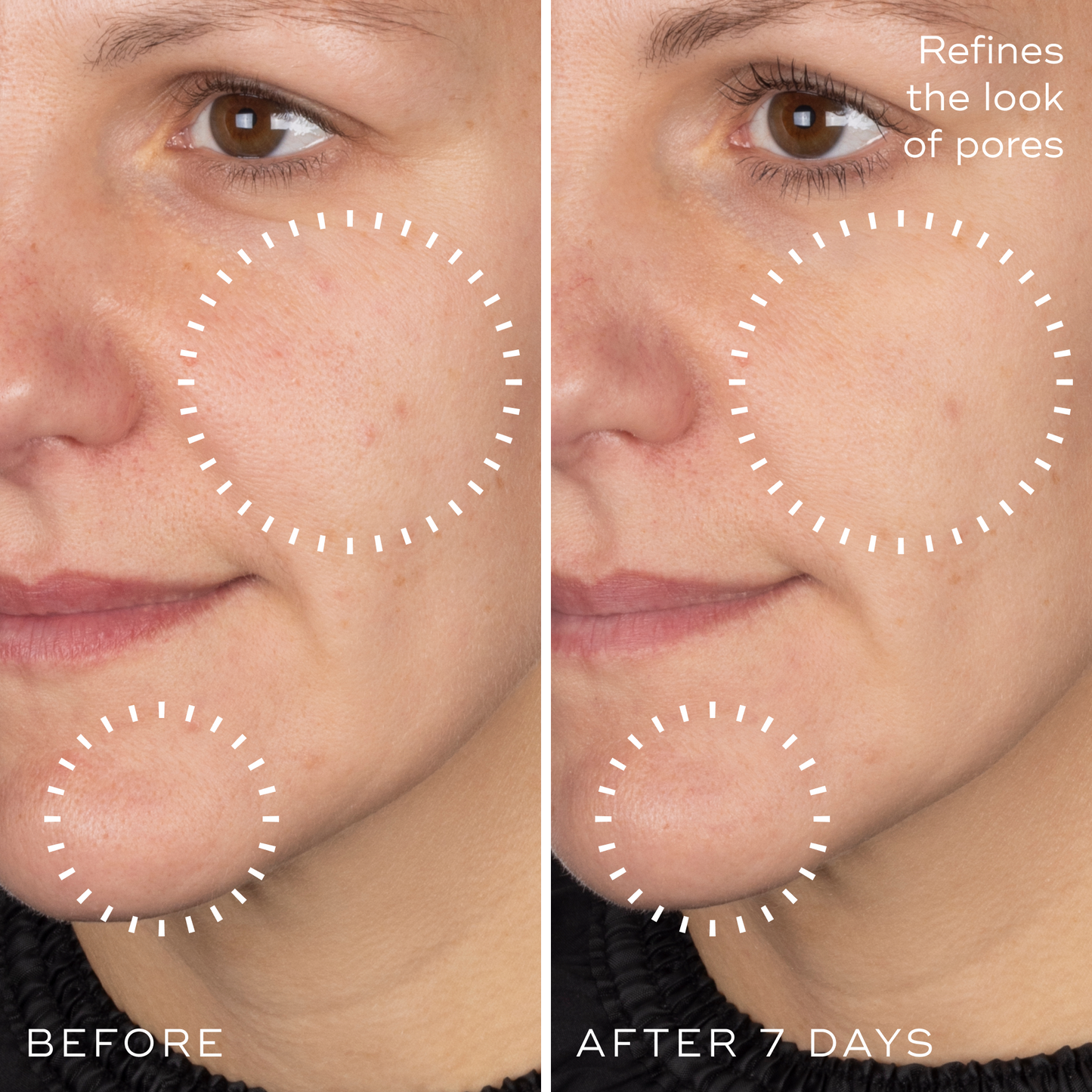 Before and after photographs of a woman's cheek and chin after 7 days using Medik8 Niacinamide Peptides, showing refined pores.